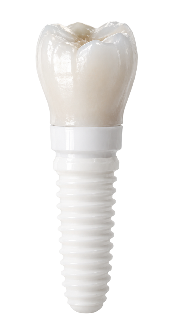 Implante dental premium Clínica Jade